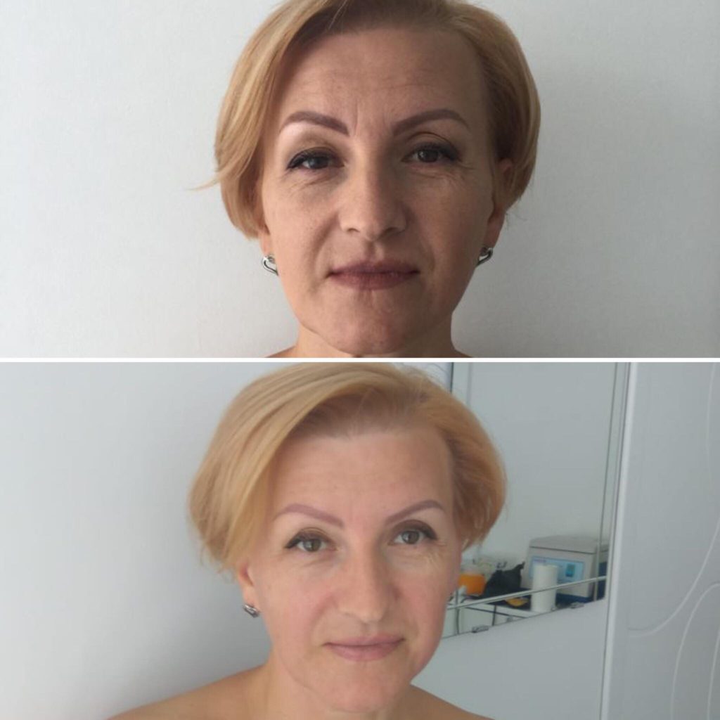Фото до и после массажа лица 